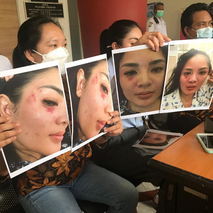 <p>Nindy Ayunda menunjukkan bukti kekerasan rumah tangga yang diterimanya selama ini. (Foto: Hanif/detikHOT)</p>