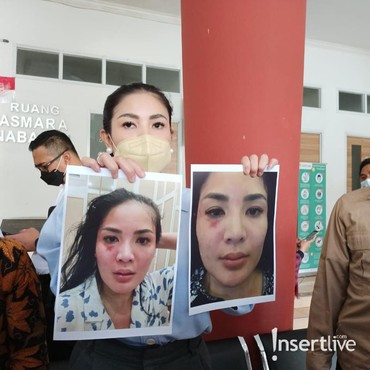 Nindy Ayunda Beberkan Bukti KDRT Suami, Wajah Luka-luka & Rambut Rontok