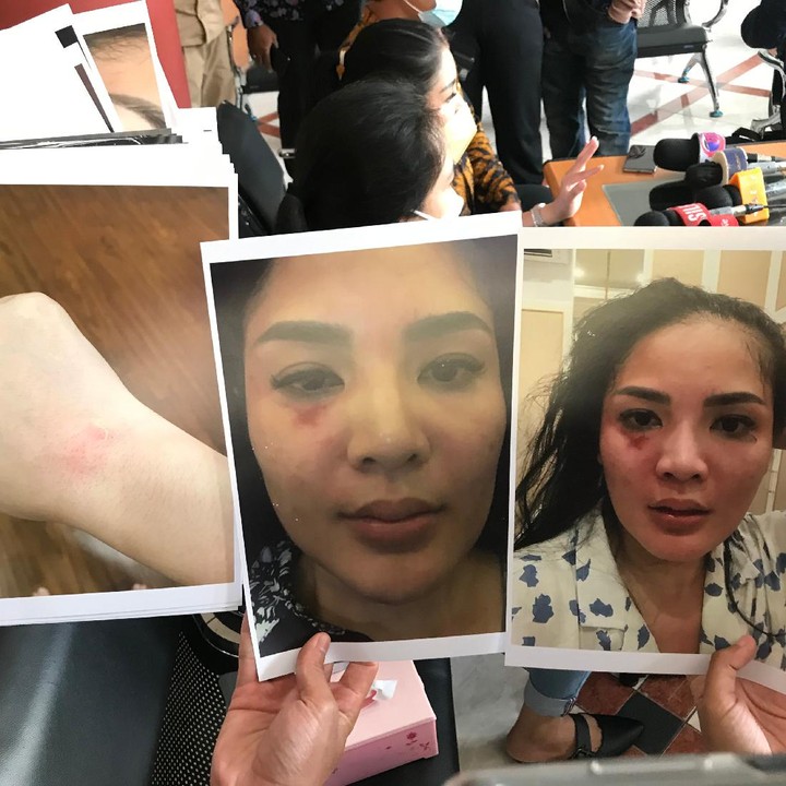 <p>Selain wajah, luka bekas KDRT juga terdapat di bagian tubuh lain seperti tangan. (Foto: Hanif/detikHOT)</p>