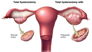 EFEK PCOS YANG KERAP TERJADI