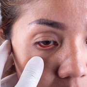 Ternyata Ada 4 Jenis Mata Panda, Penyebab dan Cara Mengatasinya Juga Berbeda Lho!