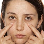 Tips Menghilangkan Kantung Mata dari Dr. Richard Lee