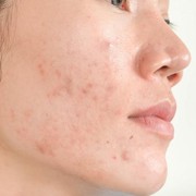 Ladies Perlu Tahu, Ini Perbedaan PIH, PIE dan Scars