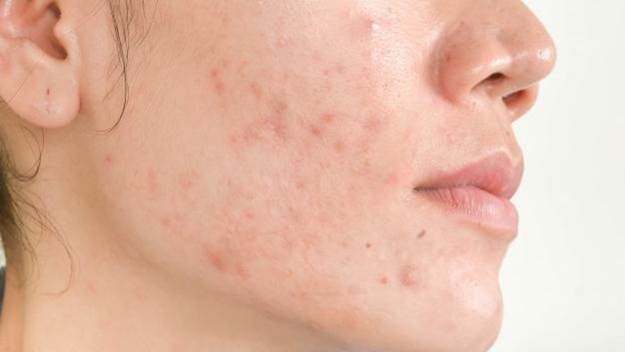 Ladies Perlu Tahu, Ini Perbedaan PIH, PIE dan Scars