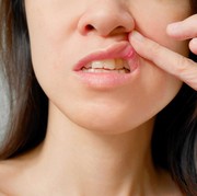 Kamu Sudah Tahu? Ternyata Ini Penyebab, Gejala, sampai Cara Mengobati Sariawan pada Mulut yang Mengganggu!