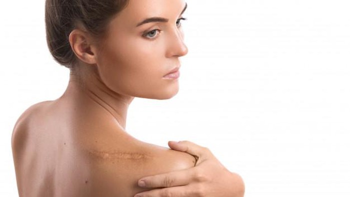 Ladies, Begini 5 Cara Hilangkan Bekas Luka yang Menghitam