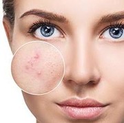 Rekomendasi Sabun Muka Salicylic Acid Murah Berkualitas untuk Berantas Jerawat