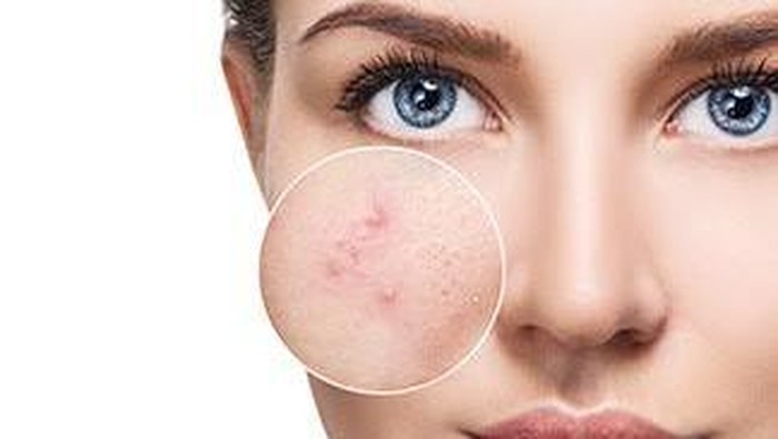 Rekomendasi Sabun Muka Salicylic Acid Murah Berkualitas untuk Berantas Jerawat