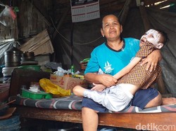 Viral Anak Lumpuh di Surabaya Tinggal di Gubuk