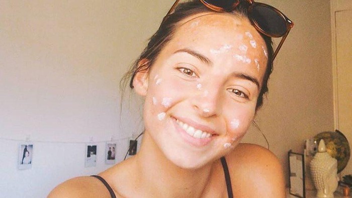 Biar Jerawat Terangkat, Begini 5 Cara Pakai Acne Patch yang Benar