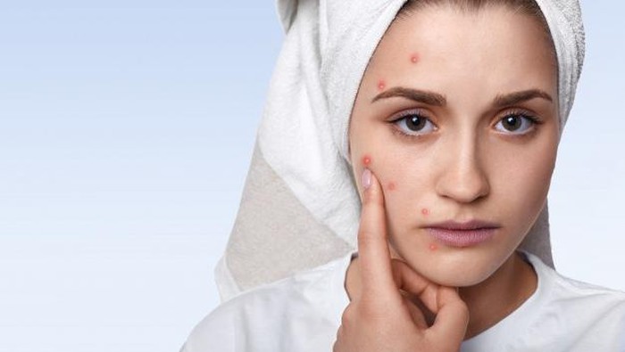 8 Do's and Don'ts Saat Kulit Wajah Sedang Berjerawat