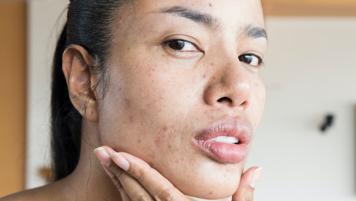 Cara Ampuh untuk Atasi Jerawat Pasir