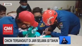 VIDEO: Cincin Tersangkut di Jari Selama 10 Tahun
