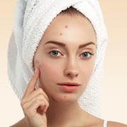 Rekomendasi 6 Acne Lotion Lokal dan Murah untuk Keringkan Jerawat dengan Cepat