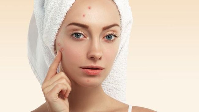 Rekomendasi 6 Acne Lotion Lokal dan Murah untuk Keringkan Jerawat