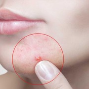 Kulit Berjerawat, Kering, dan Kusam, Mana yang Harus Diatasi Terlebih Dahulu?