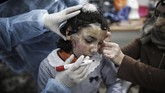 FOTO: Masker 3D untuk Sembuhkan Luka Bakar Sejumlah korban kebakaran kamp pengungsi Palestina di Gaza mengenakan masker 3D untuk menyembuhkan luka bakarnya. Masker berperan dalam mempercepat penyembuhan.