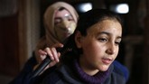 FOTO: Masker 3D untuk Sembuhkan Luka Bakar Sejumlah korban kebakaran kamp pengungsi Palestina di Gaza mengenakan masker 3D untuk menyembuhkan luka bakarnya. Masker berperan dalam mempercepat penyembuhan.