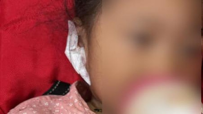 Anting terjebak di lubang telinga balita