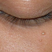 Pernah Dengar Milia? Begini 5 Cara Mudah Mengatasi Milia Membandel!