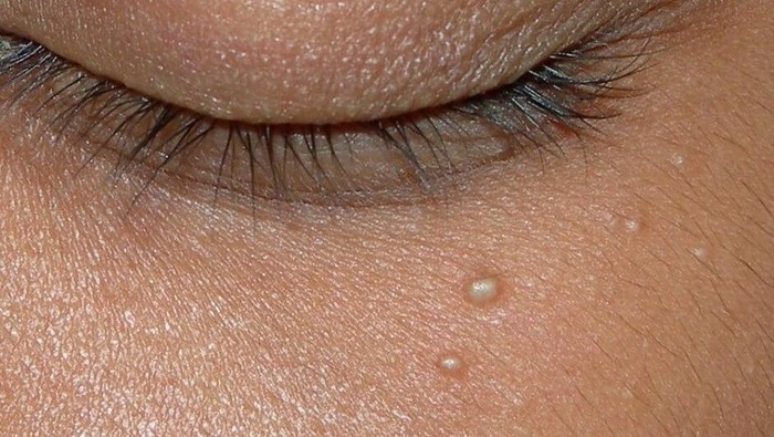 Pernah Dengar Milia? Begini 5 Cara Mudah Mengatasi Milia Membandel!