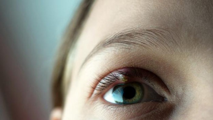 Mata Bintitan di Waktu yang Tidak Tepat? Intip Cara Ampuh Mengatasinya!