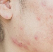 Waduh! Ternyata Ini 5 Hal Kecil yang Bikin Jerawat Semakin Memburuk