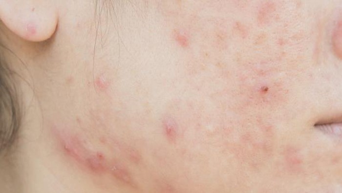 Waduh! Ternyata Ini 5 Hal Kecil yang Bikin Jerawat Semakin Memburuk