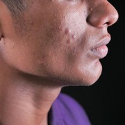 Solusi Ampuh Atasi Jerawat dengan Acne Patch Lambena