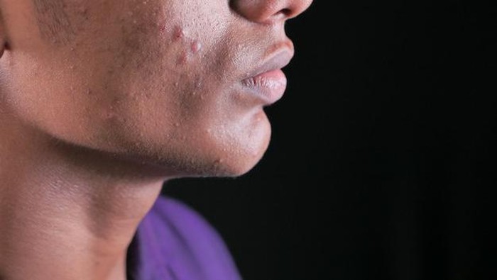 Solusi Ampuh Atasi Jerawat dengan Acne Patch Lambena