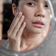 Bikin Gagal Glowing! Wajib Tahu Penyebab Noda Gelap di Wajah Akibat Hiperpigmentasi