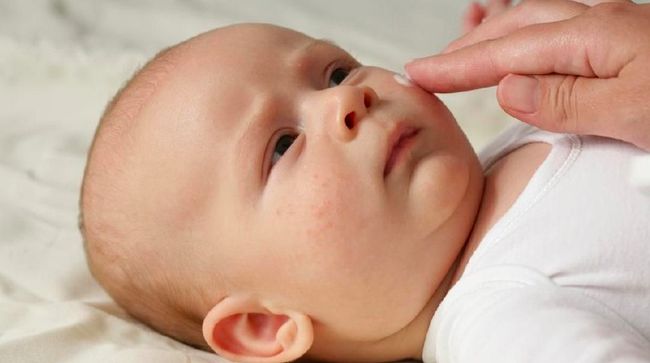 Jenis Bintik Merah Pada Kulit Bayi Dan Cara Mengatasinya