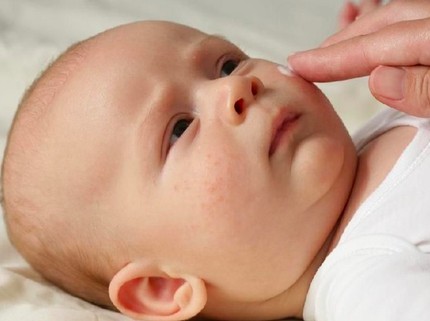 Jenis Bintik Merah Pada Kulit Bayi dan Cara Mengatasinya
