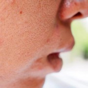 Duh, Pori-Pori Kayak Kulit Jeruk! Begini Cara Mengatasinya