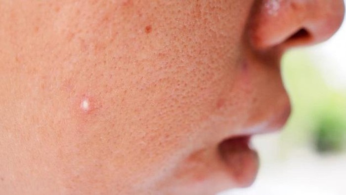 Duh, Pori-Pori Kayak Kulit Jeruk! Begini Cara Mengatasinya