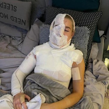 Wajah Penari Inggris Kena Bola Api, Begini Kondisinya Sekarang