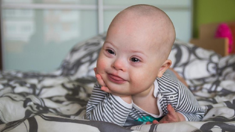 Down Syndrome Down Syndrome