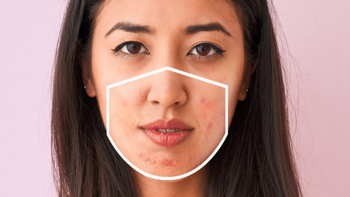 6 Langkah Tepat Merawat Kulit Maskne, Gak Ganggu Lagi!