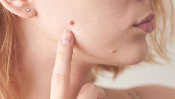 Hati-Hati! Ini Perbedaan Tahi Lalat Biasa dan Tahi Lalat Berbahaya, Cari Tahu Sekarang!