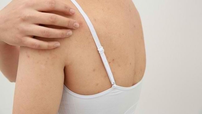 6 Rekomendasi Sabun yang Cocok untuk Obati Jerawat Badan 6 Rekomendasi Sabun yang Cocok untuk Obati Jerawat Badan