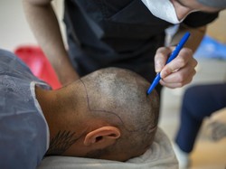 Transplantasi Rambut: Manfaat, Risiko, dan Kisaran Biaya