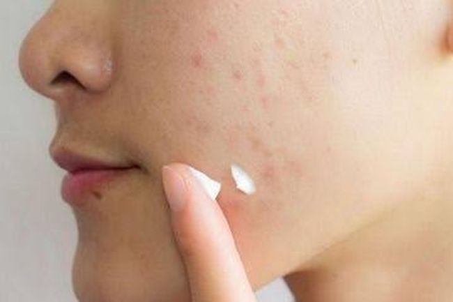 5 Skincare untuk Menghilangkan Bekas Jerawat, Ada Produk Lokal!