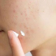 5 Skincare untuk Menghilangkan Bekas Jerawat, Ada Produk Lokal!