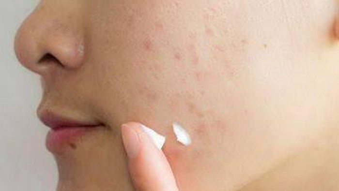 5 Skincare untuk Menghilangkan Bekas Jerawat, Ada Produk Lokal!