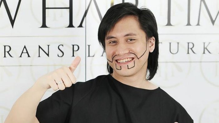 Rela Terbang ke Turki, Kevin Aprilio Lakukan Cangkok Rambut! Apa Itu?