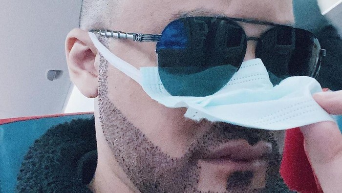 Fakta Cangkok Rambut ala Kevin Aprilio, Benarkah Bikin Subur?