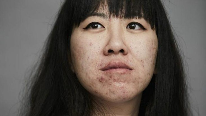 Bekas Jerawat Ternyata Ada Jenisnya, Cek Untuk Tahu Bedanya!