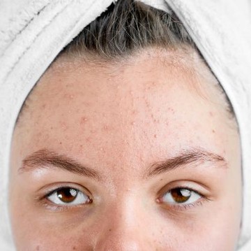 img-title Bukan Jerawat Biasa, Kenali 6 Langkah Tepat Merawat Fungal Acne