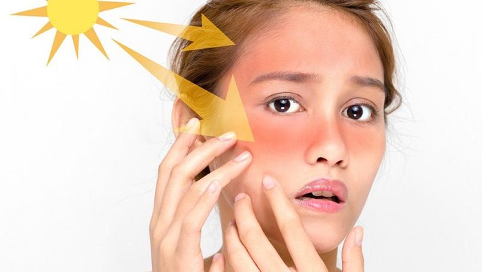 Sunburn? Atasi dengan 6 Cara Ini Yuk!