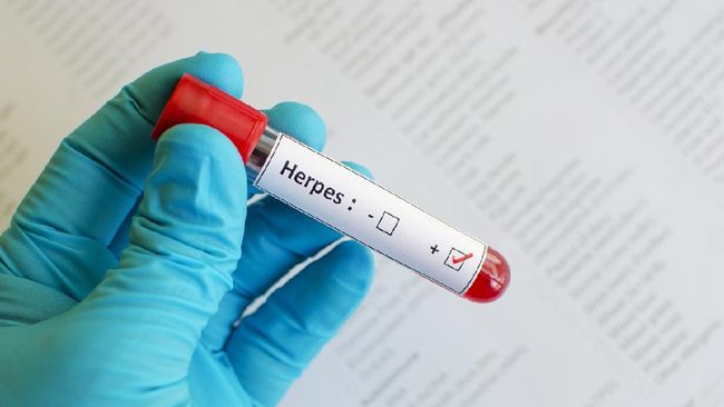 Studi terbaru menemukan asal muasal virus herpes mulai menyebar dengan luas. Virus diklaim mulai menyebar luas saat orang-orang mulai mengenal ciuman.